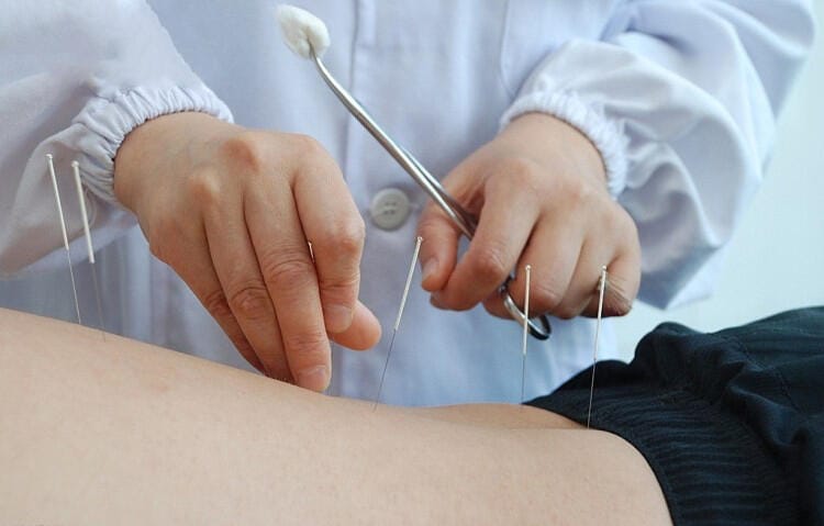 Bác sĩ thực hiện châm cứu trị liệu đau cột sống thắt lưng và đả thông kinh lạc vùng lưng
